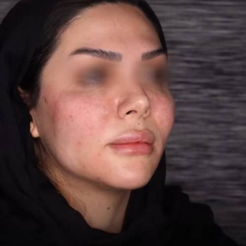 تزریق فیلر فول فیس