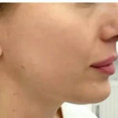 فرم دهی چانه با فیلر