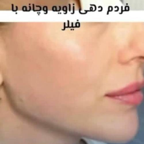 فرم دهی چانه با فیلر