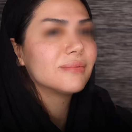تزریق فیلر فول فیس
